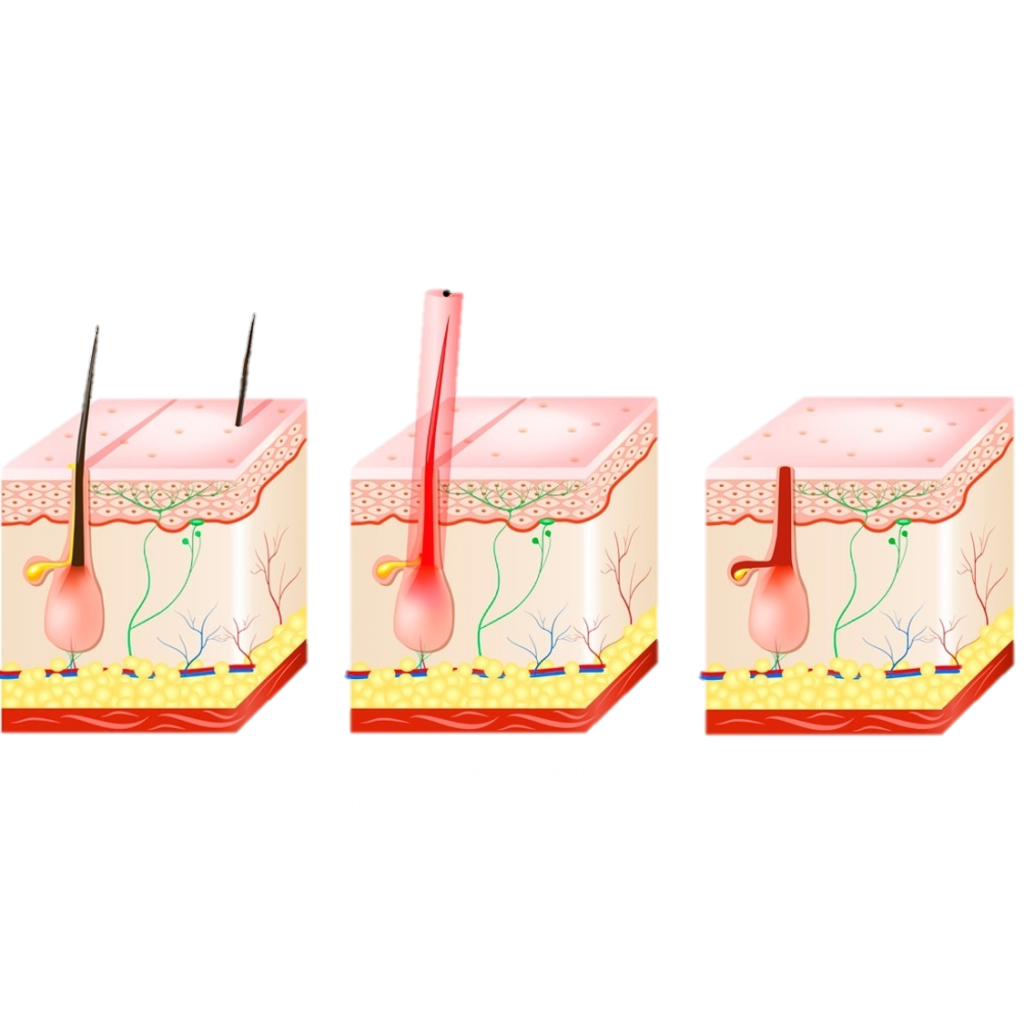 Depilacion SHR proceso